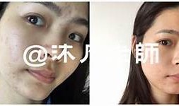 有效去除抖阴痘印的方法与护理秘诀，重拾光滑肌肤