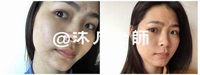 有效去除抖阴痘印的方法与护理秘诀，重拾光滑肌肤